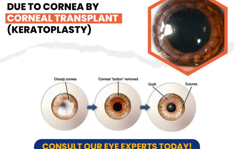 Corneal Transplantation at Shreya Eye centre